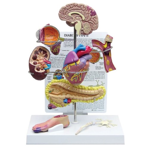 Cukrzyca typu II - zestaw anatomiczny
